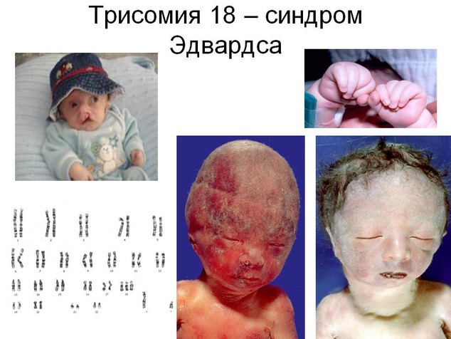 Как выглядит ребенок синдромом эдвардса