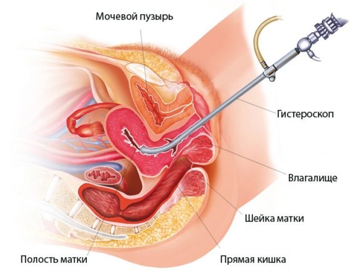 гистероскопия гистероскопия