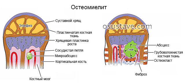 остеомиелит