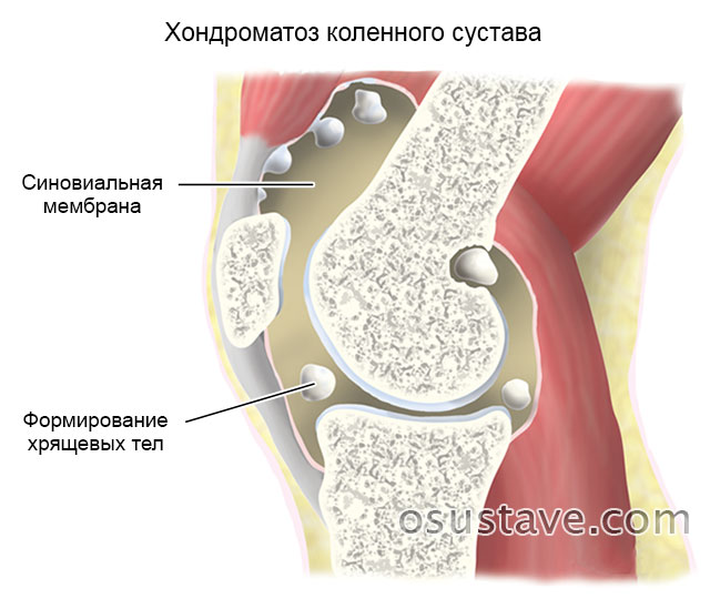 хондроматоз коленного сустава
