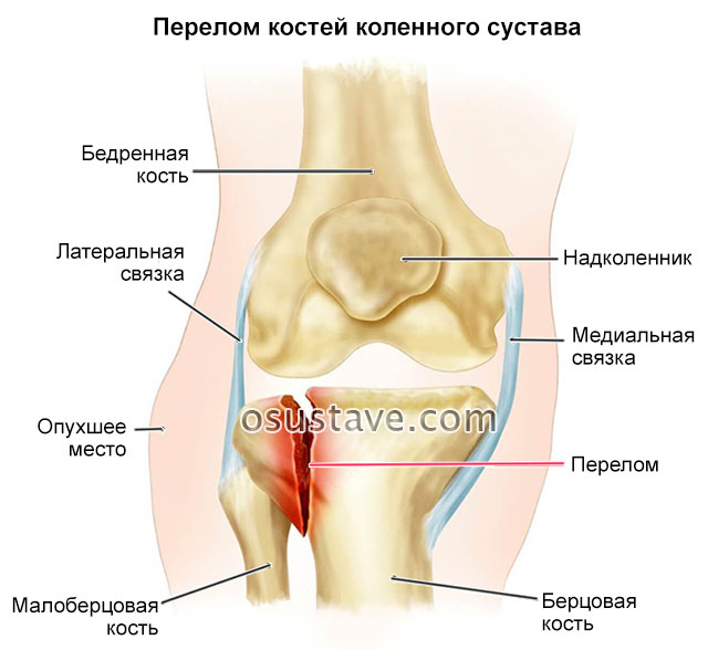 перелом костей коленного сустава