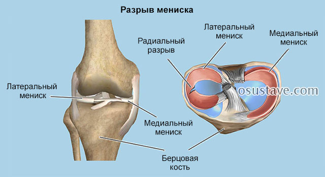 разрыв мениска