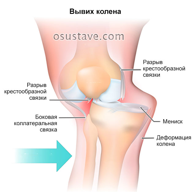 вывих коленного сустава