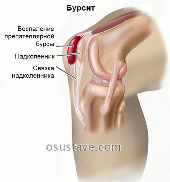 бурсит коленного сустава