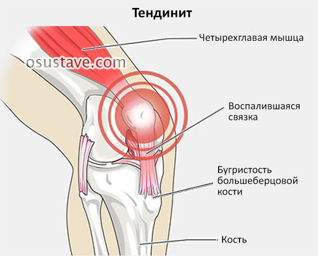 тендинит колена