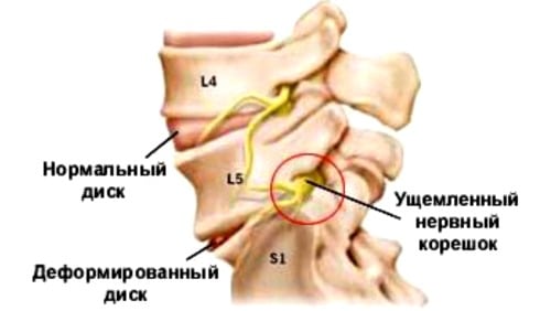 Современное лечение остеохондроза с корешковым синдромом