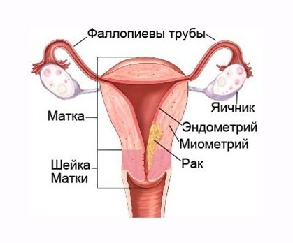 Аденокарцинома матки Аденокарцинома матки