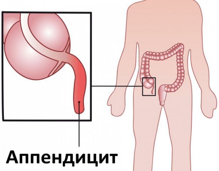 Болевой синдром при заболеваниях органов брюшной полости