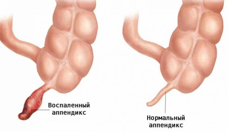 Болевой синдром при заболеваниях органов брюшной полости