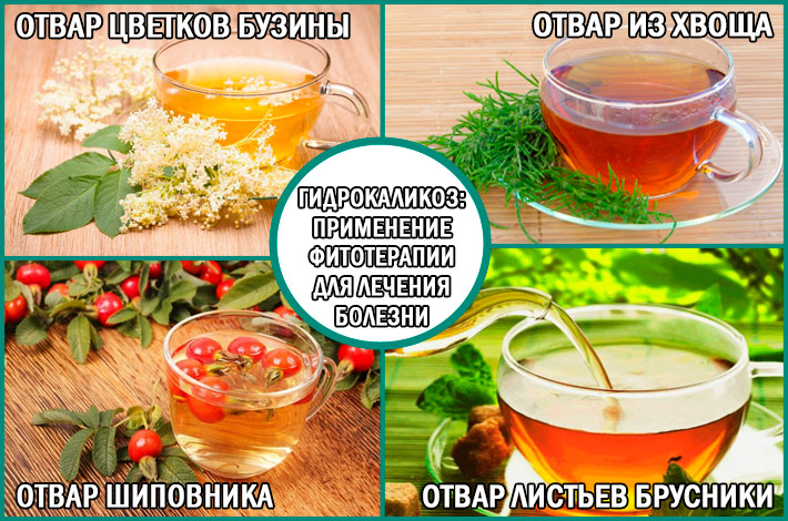 Гидрокаликоз: применение фитотерапии для лечения болезни Применение фитотерапии для лечения гидрокаликоза