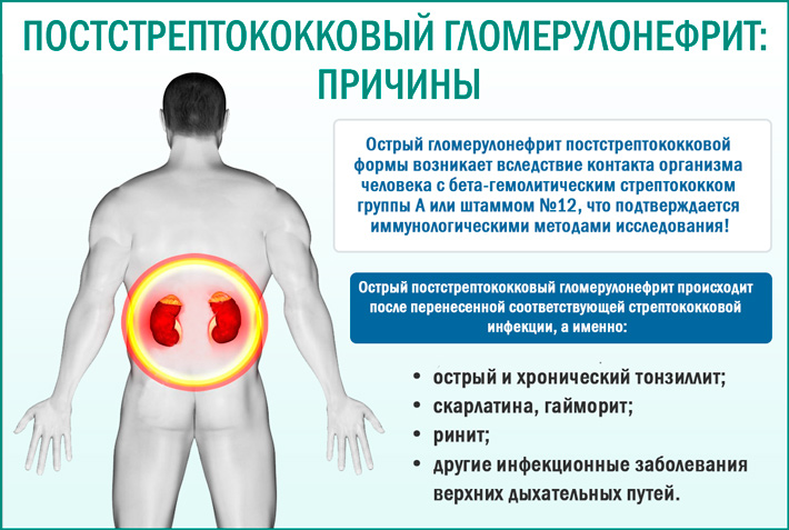 Постстрептококковый гломерулонефрит: причины Острый постстрептококковый (постинфекционный) гломерулонефрит: причины