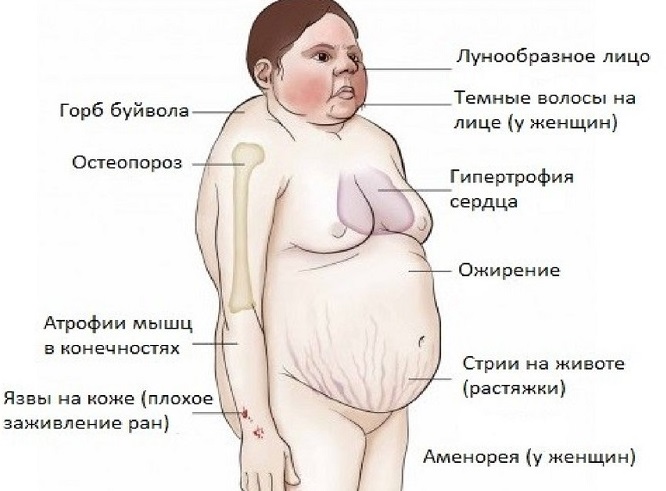 Фото больных синдромом иценко кушинга