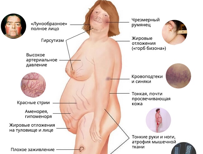 Фото больных синдромом иценко кушинга