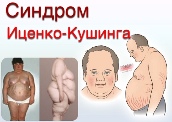 Фото больных синдромом иценко кушинга