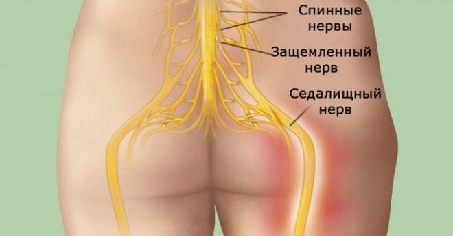 Защемление седалищного нерва