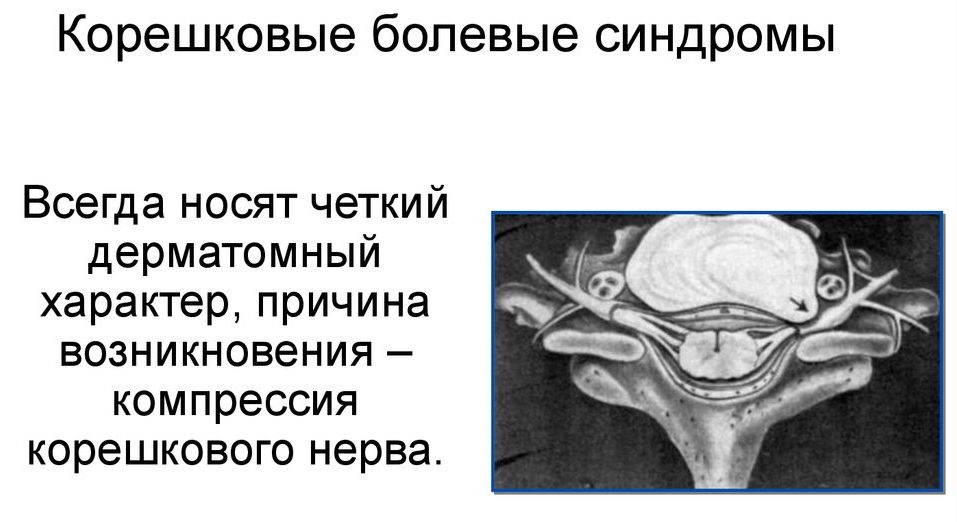 Корешковые болевые синдромы