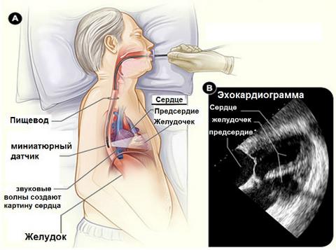 Чреспищеводная эхокардиография Чреспищеводная эхокардиография