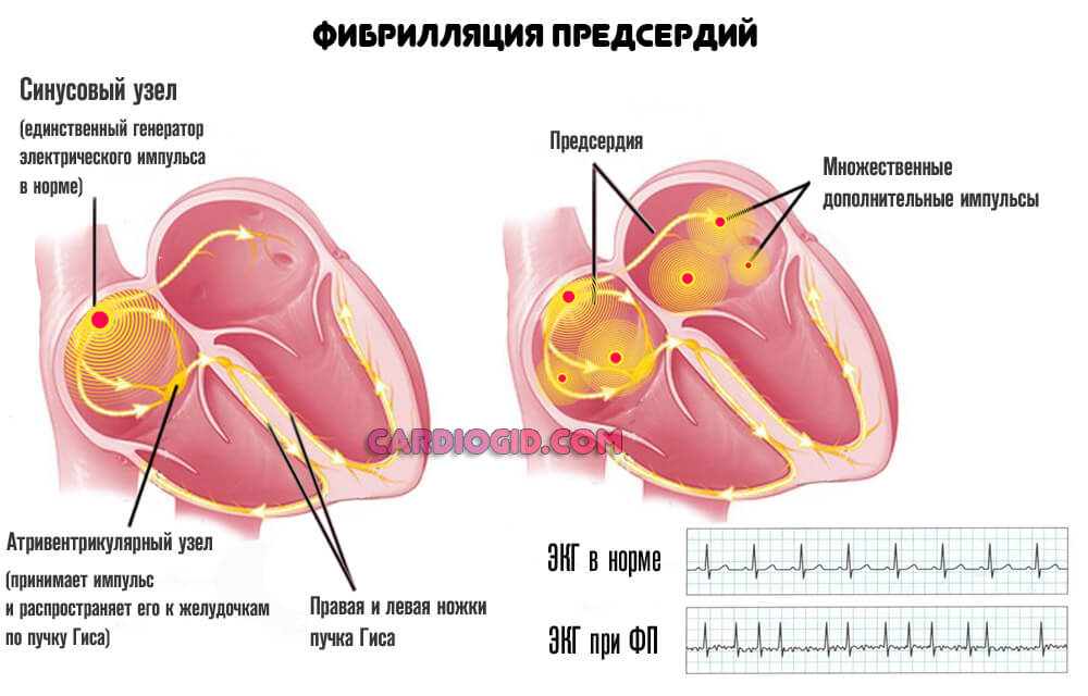 фибрилляция предсердий
