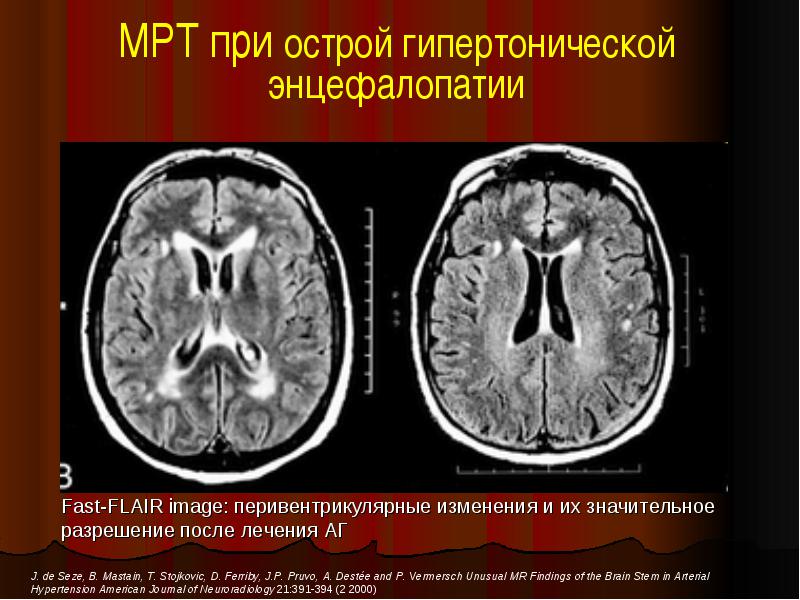Гипертоническая энцефалопатия