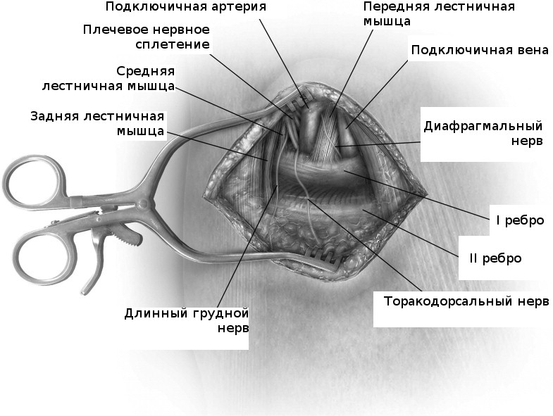 Операция при синдроме грудного выхода