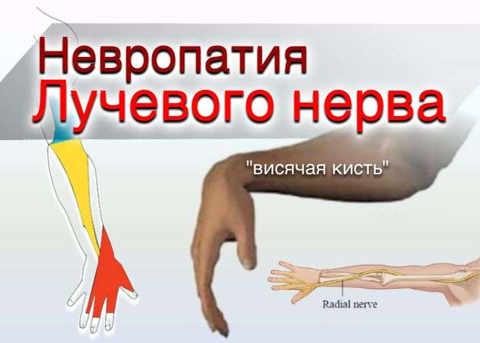 нейропатия лучевого нерва