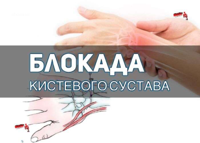 лечебная блокада лучезапястного сустава