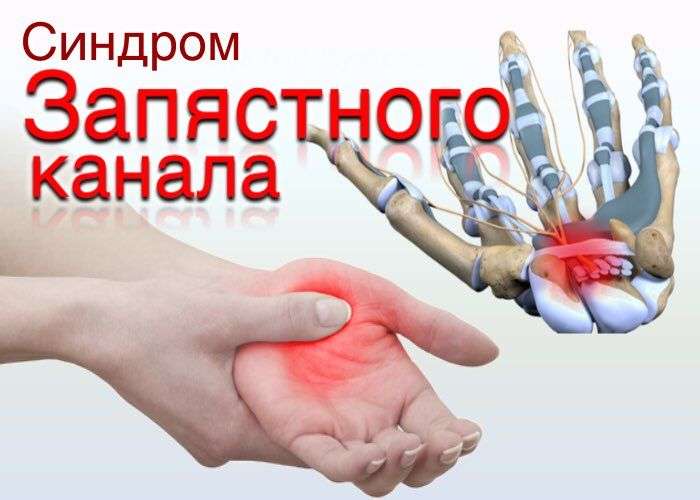 синдром запястного канала