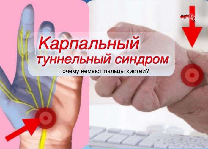 Карпальный туннельный синдром: причины, симптомы, лечение Карпальный туннельный синдром: причины, симптомы, лечение