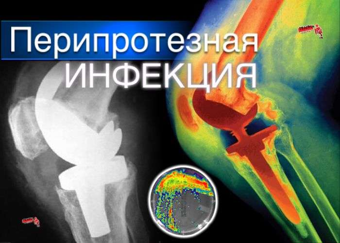 Перипротезная инфекция в ортопедии - проблема сегодняшнего дня Перипротезная инфекция в ортопедии - проблема сегодняшнего дня