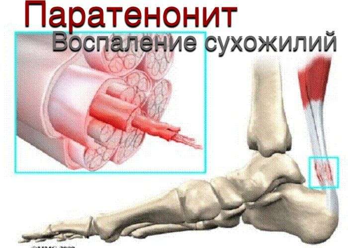 Заболевания соединительнотканных образований мышц