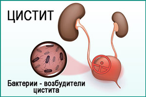 Возбудители цистита Бактериальный цистит
