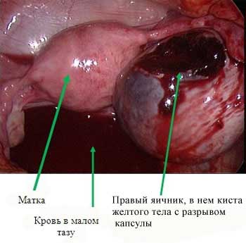 Киста желтого тела (интраоперационно)