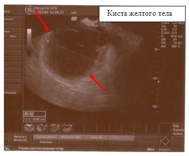 Киста желтого тела на УЗИ-исследовании
