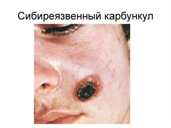 Фурункул пальца код мкб