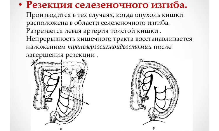 Резекция селезеночного изгиба Резекция селезеночного изгиба