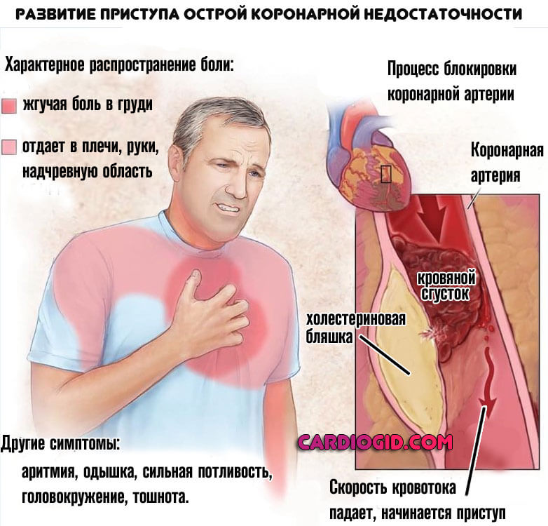 острая-коронарная-недостаточность