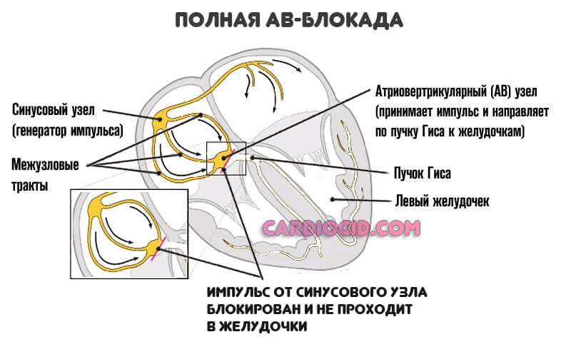 полная-ав-блокада