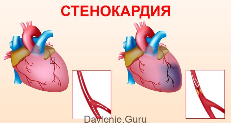 Стенокардия