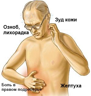 Симптомы холангита Холангит