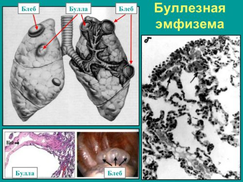 Буллезная эмфизема Буллезная эмфизема