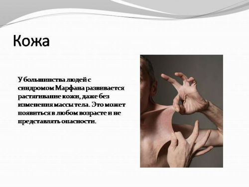 Кожа при синдроме Марфана Кожа при синдроме Марфана