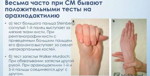 Арахнодактилия Арахнодактилия