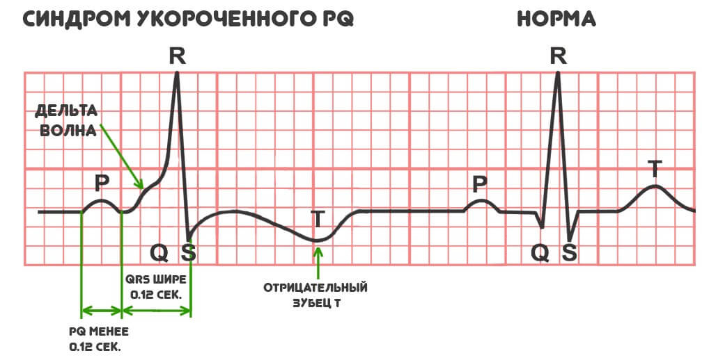 Укороченный pq код по мкб 10