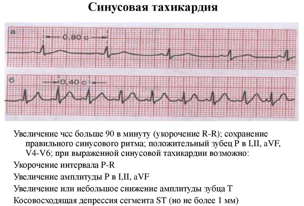 Синусовая тахикардия на экг