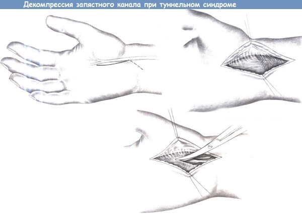 Тоннельный синдром запястного канала. Симптомы и лечение. Гимнастика, народные средства, операция